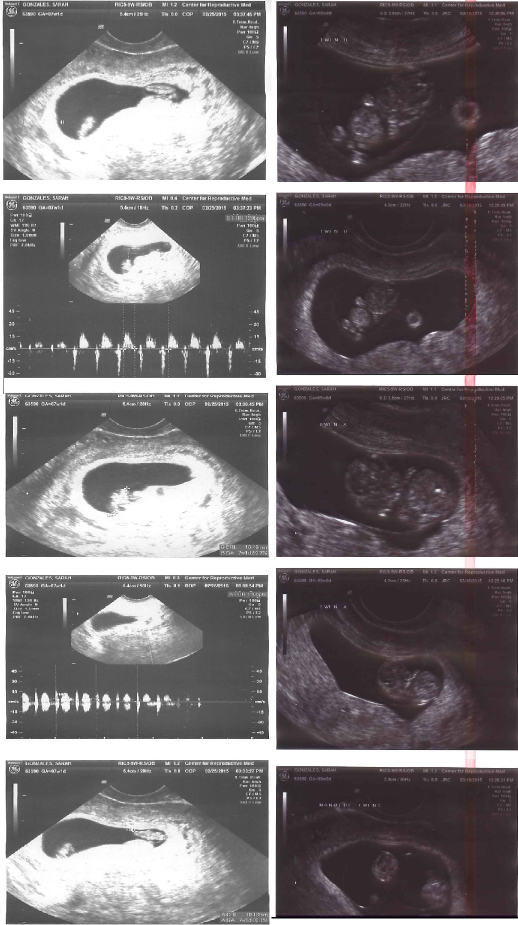 Pregnant With Twins Ultrasound 17